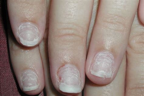 12 Beauty Hacks For Repairing Damaged Nails Hergamut