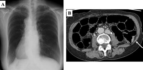 Chest radiography and abdominal computed tomography of the patient. (A ...