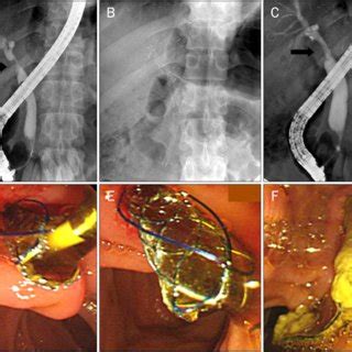 PDF Fully Covered Self Expandable Metal Stent For The Treatment Of