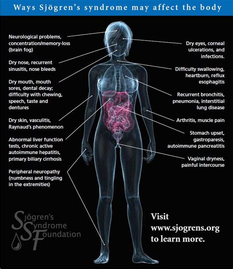 Symptoms Of Sjogrens