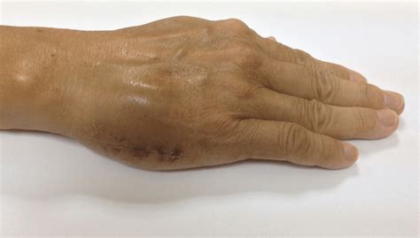 Photograph Of The Swelling On The Dorsum Of The Right Hand Download