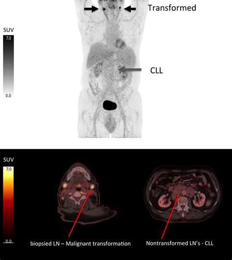 Fdg‐petct In The Management Of Lymphomas Current Status And Future