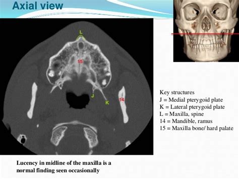 Maxilla anatomy, development & surgical anatomy
