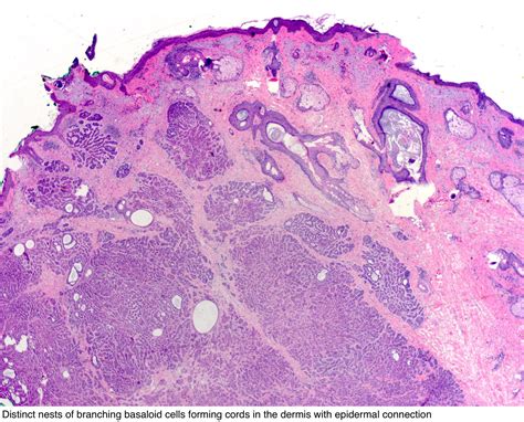 Pathology Outlines Basaloid Follicular Hamartoma