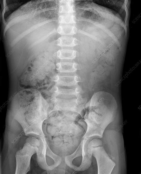 Swallowed Marble X Ray Stock Image C0177748 Science Photo Library