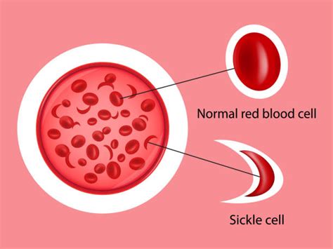 Sickle Blood Stock Vectors Istock