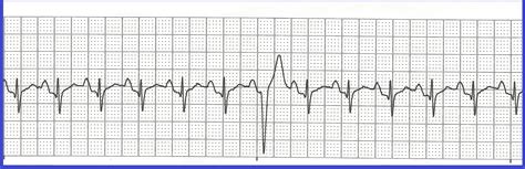 Sinus Tachycardia With Pvc All In One Photos