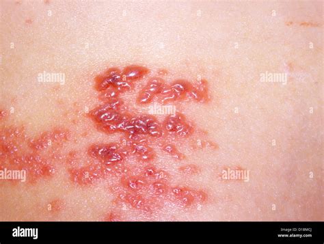 Herpes Zoster Hi Res Stock Photography And Images Alamy