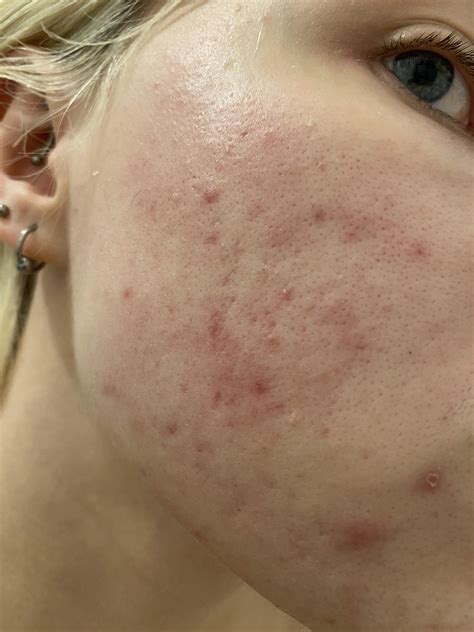 Skin Concern Does Anyone Have Any Idea If This Is Irritation Or An