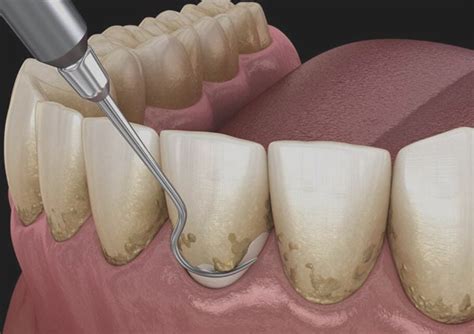 Periodontal Specialists Gum Disease Treatment Dentist Stamford