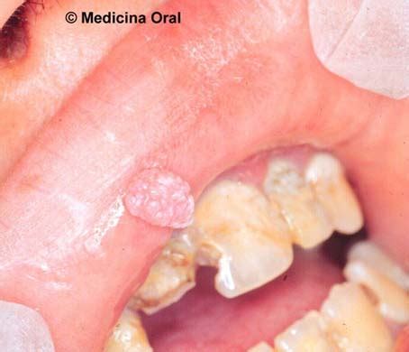 Atlas Clinico De Medicina Oral