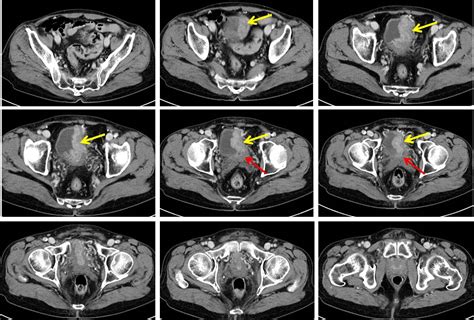 Urinary Bladder Carcinoma Radiology Cases