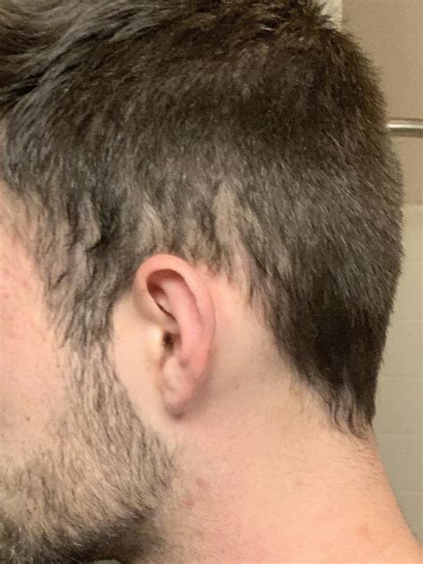 Thinning Around The Ear Im Seeing This On Both Sides Not Seeing A