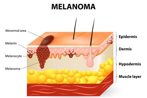 Metastatic Melanoma Causes Symptoms Prognosis And Treatment Page