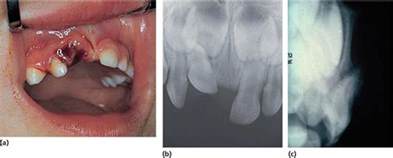 Tooth Intrusion Radiograph