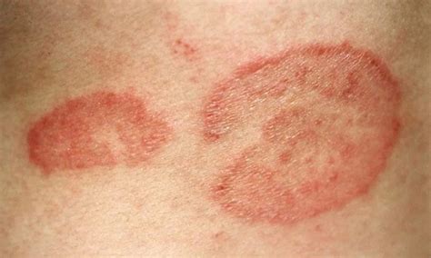 Ringworm Symptoms Causes And Treatment Fajar Magazine