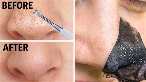 How To Remove Blackheads From Nose And Face 12 Best Natural Tips
