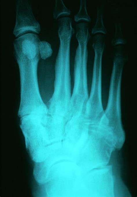 Osteoarthritis Of Foot Photograph By Dr P Marazzi Science Photo Library