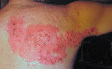 Do I Have Shingles Symptoms Causes And Natural Remedies For Shingles
