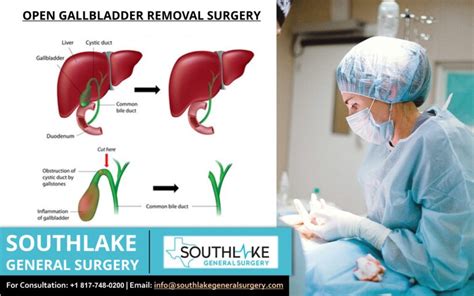 Open Gallbladder Removal Surgical Procedure Southlake General Surgery