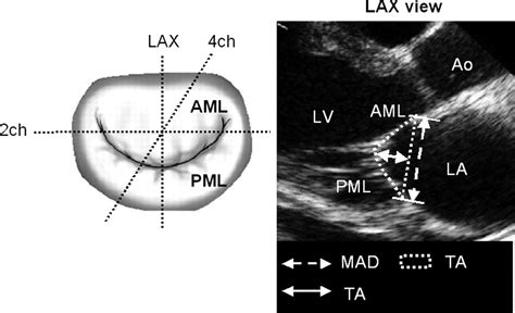 Mitral Valve Repair With Carpentier Mccarthy Adams Imr Etlogix