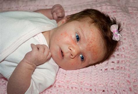 8 Effective Home Remedies For Treating Baby Rash On Face