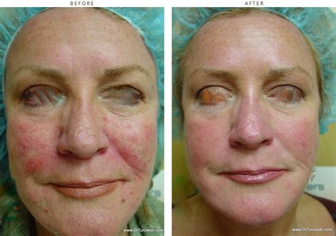 Intense Pulse Light Ipl Before And After Pictures Dr Turowski Plastic Surgery Chicago