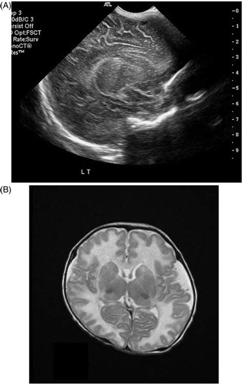 Neonatal Brain Ultrasound Showed Ill Defined Gray White Matter