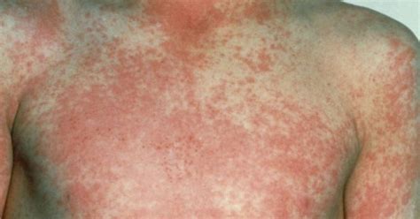 More Than A Dozen Cases Of Scarlet Fever Discovered In Oxfordshire As Uk Infection Rates Rise
