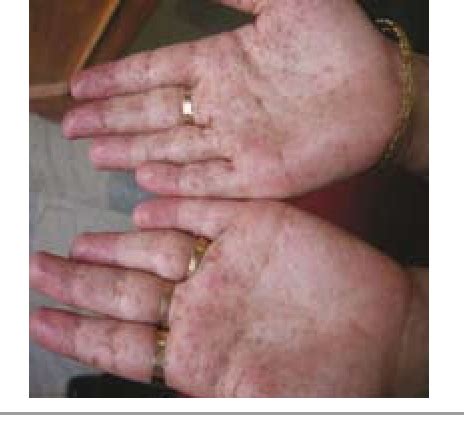 Figure From Palmar Pit Like Lesions As A Rare Presentation In