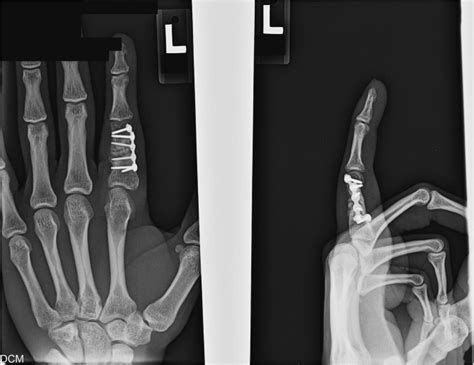 Nonunion In Nonarticular Phalanx Fractures Musculoskeletal Key