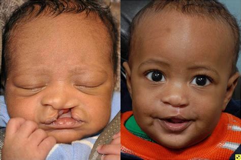 Cleft Lip Before And After