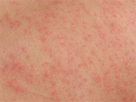Pictures Of Skin Rashes Different Type Of Skin Rashes Healthy
