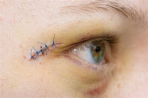 Human Face Stitches Scar Human Eye Stock Photos Pictures And Royalty