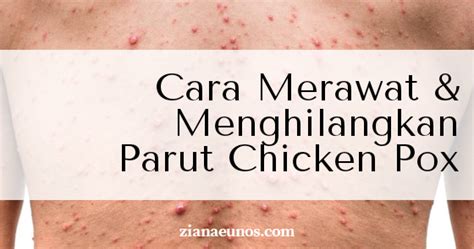 Has your child developed chicken pox? Cara Merawat dan Menghilangkan Parut Chicken Pox Dengan ...