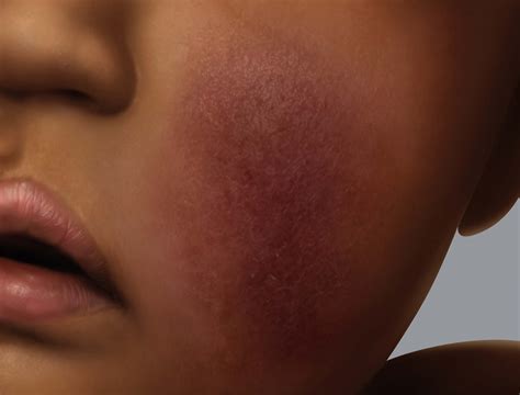 Eczema On Dark Skin Eczema Foundation