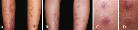 Red Papules And Pustules Violaceous Plaques With A Depressed Or Eroded