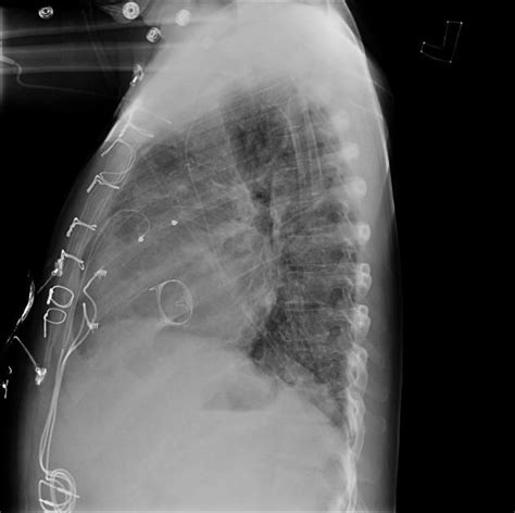 Tricuspid Valve Replacement Radiology Case