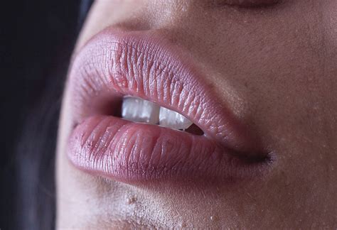 Eingerissene Mundwinkel Ursachen Tipps Was Wirklich Hilft