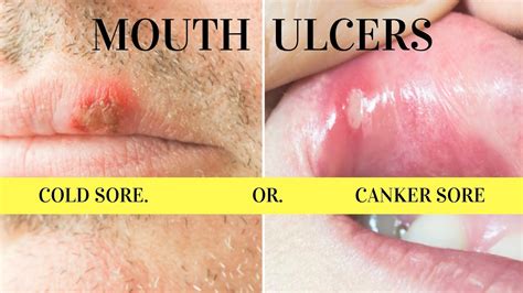mouth ulcers difference between canker apthous sores and cold herpes sores youtube