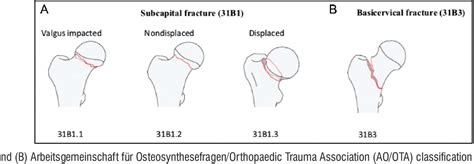Figure From Classification Of Fracture Neck Of Femur Semantic Scholar