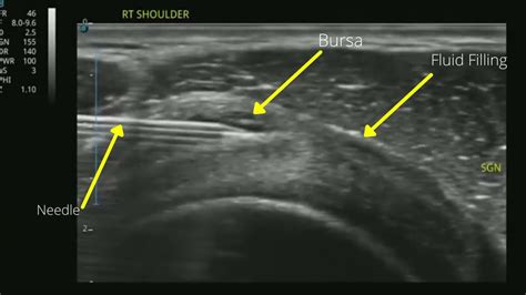 Ultrasound Guided Injection Shoulder Subacromial Bursa The Podiatry
