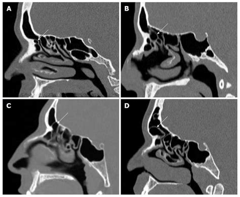 Evaluation Of Variations In Sinonasal Region With Computed Tomography