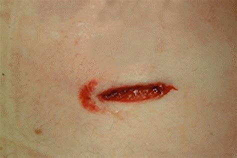 Knife Wounds Patterns Godoy Medical Forensics