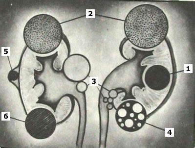 Что такое солитарная киста почки Картинка - Что такое солитарная киста почки