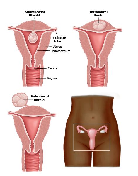 Fibroid Awareness What You Need To Know Health Matters Uf Health Jacksonville University