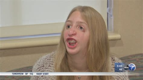 Teen Talks About Living With Treacher Collins Syndrome Abc7 Chicago