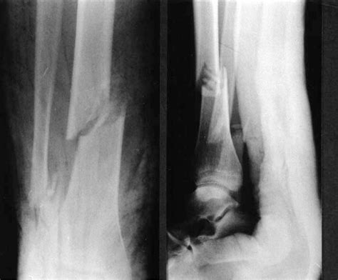 Figure 1 From Laceration Of Tibialis Anterior Tendon Complicating A