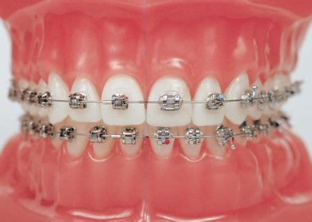 As of mar 14, 2021, the average annual pay for an oral surgeon in the united states is $301,828 a year. How Much Do Braces Cost Without Insurance #braces # ...
