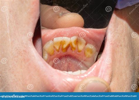 Rotten Teeth Caries And Plaque Close Up An Asocially Ill Patient The